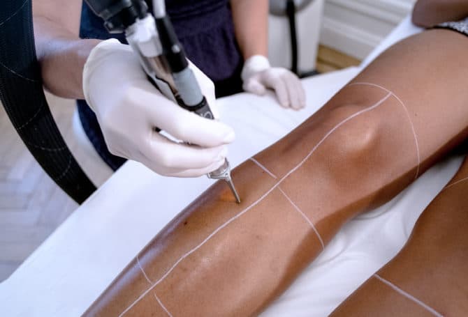 Laser hair removal on olive to dark skin with the Lyon Laser Centre