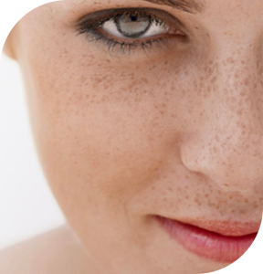 آیا لیزر درمانی تاثیری در رفع لک صورت و کک و مک دارد