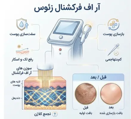 دستگاه آر اف فرکشنال زئوس