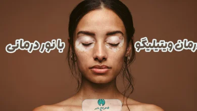 درمان بیماری ویتیلیگو با نور درمانی