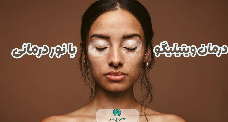 درمان بیماری ویتیلیگو با نور درمانی