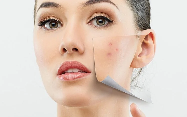 رفع جای زخم و اسکار با استفاده از درمان های نوری