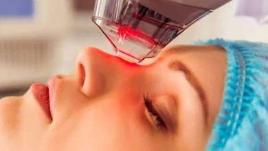 درمان جای جوش با لیزر آر اف فرکشنال