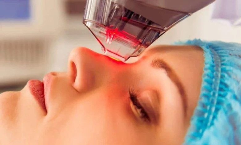 درمان جای جوش با لیزر آر اف فرکشنال