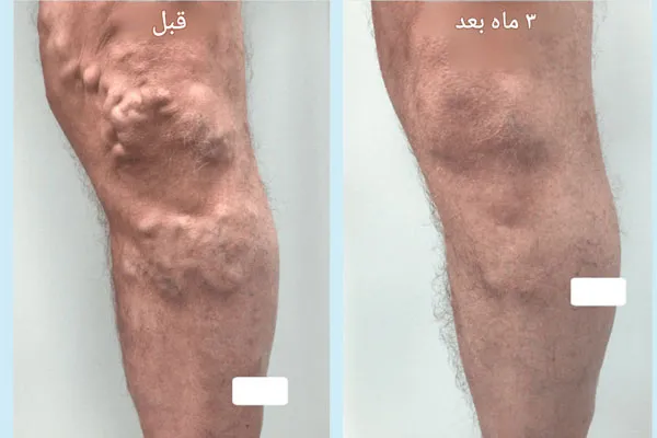 دستگاه-لیزر-کوانتا-سیستم1 تاثیر دستگاه لیزر کوانتا سیستم
